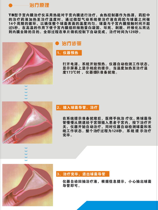 TB型子宮內膜治療儀