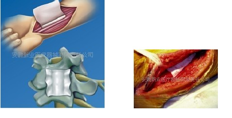 可吸收醫用膜（成都迪康）