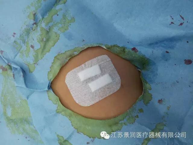 自制敷貼