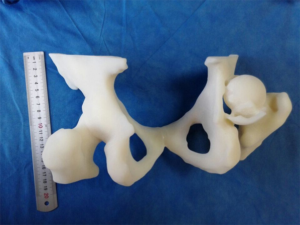 骨科新技術-3D打印手術規劃模型