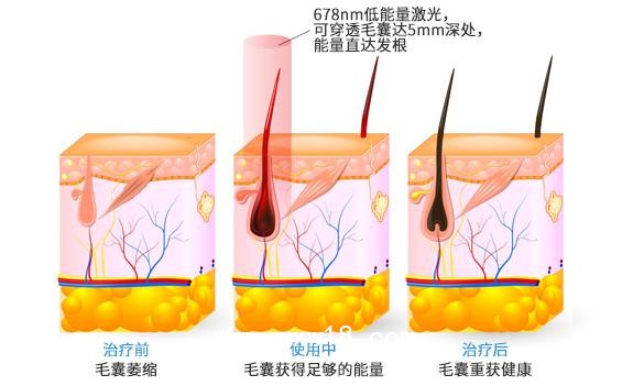“艾博拉”半導體激光生發儀、全國招商代理、加盟