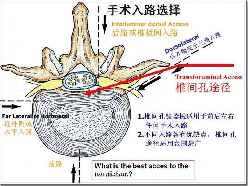 德國費格椎間孔鏡技術