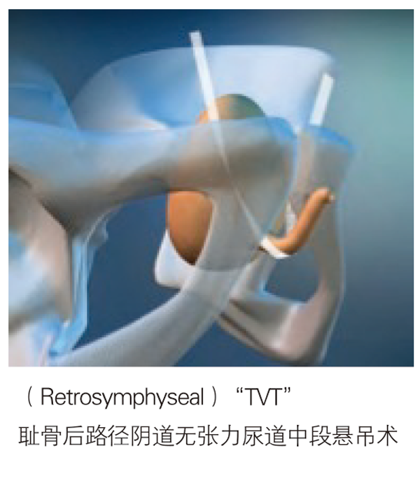 德國PVDF材質尿失禁吊帶-SIS/SIS direct