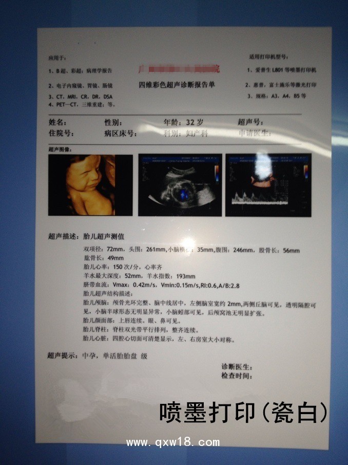 瓷白A4胃腸鏡病理B超四維彩超醫用打印膠片