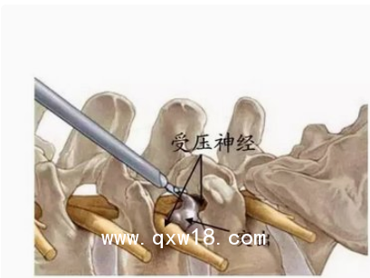 德國椎間孔鏡手術系統
