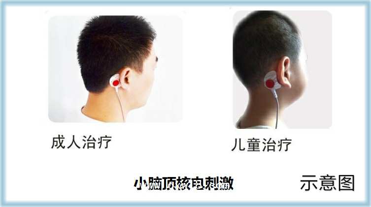 美迪泰 腦循環功能障礙治療儀 腦循環功能治療儀