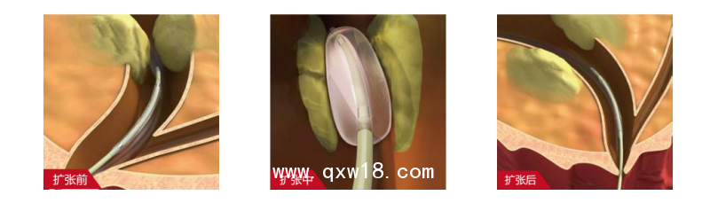 廠家供應輸尿管擴張球囊導管