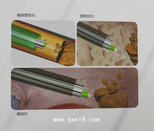 廣州萬瑪醫療科技有限公司提供維力一次性使用清石鞘