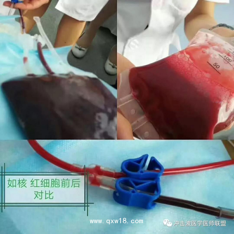 臭氧自體血血袋、三氧自體血血袋、一次性血袋