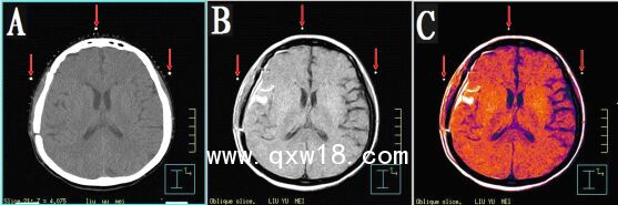 醫學圖像體外定位貼（MK⊙CT／MR）