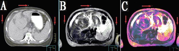 醫學圖像體外定位貼（MK⊙CT／MR）