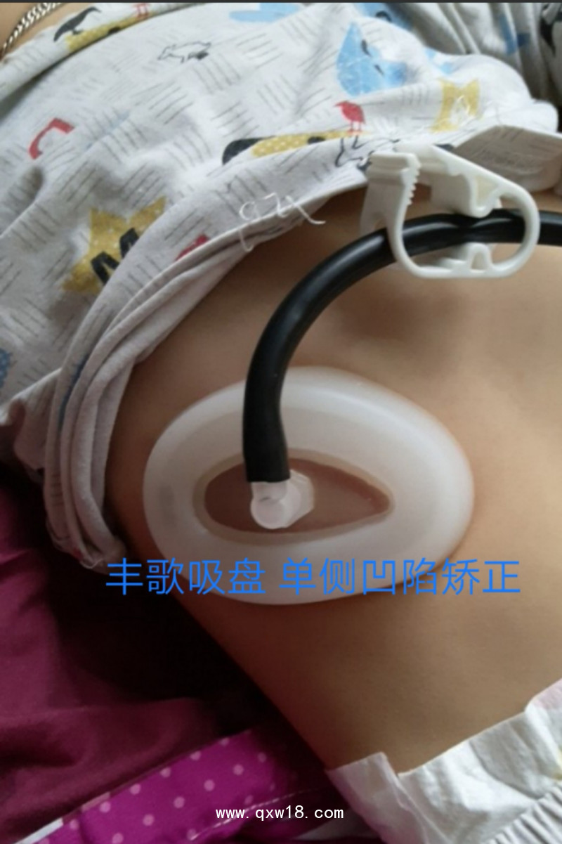 漏斗胸矯正器，負壓吸盤