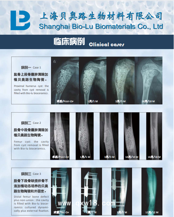國產貝奧路多孔生物陶瓷 骨科 骨缺損 脊柱融合 骨腫瘤 骨不連 關節融合