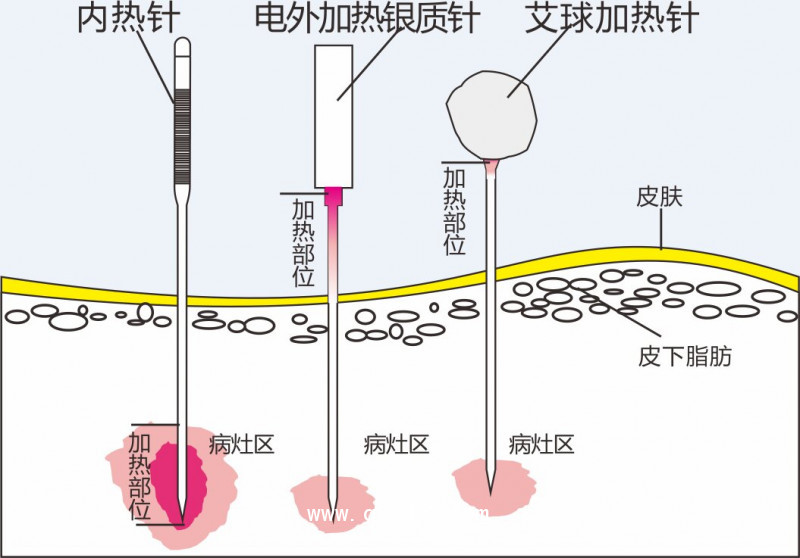內熱針治療儀針灸針 西北地區招商