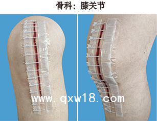 一次性皮膚縫合器/醫用無針縫合器/醫用免縫拉鏈/一次性皮膚吻合器/一次性皮膚減張器