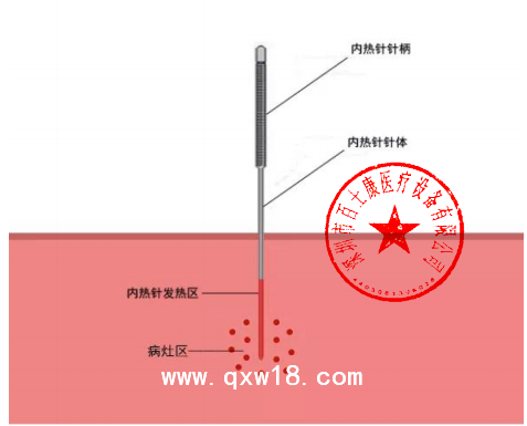 百士康0.7mm*140mm 內熱針 內熱式針灸針