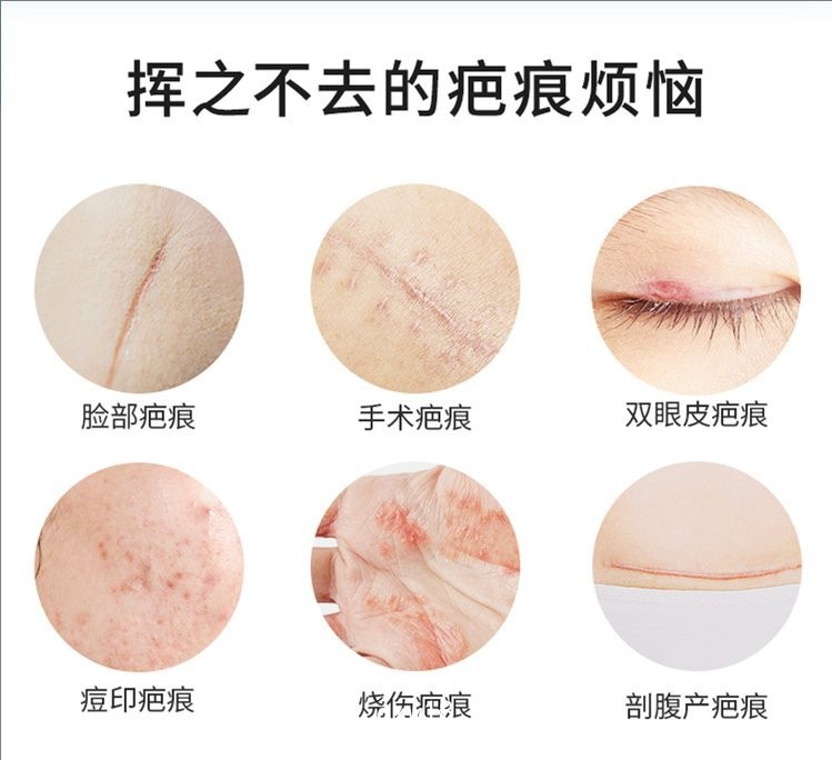 疤痕凝膠/二類械字號醫用祛疤凝膠/廠里批發可代加工疤痕凝膠