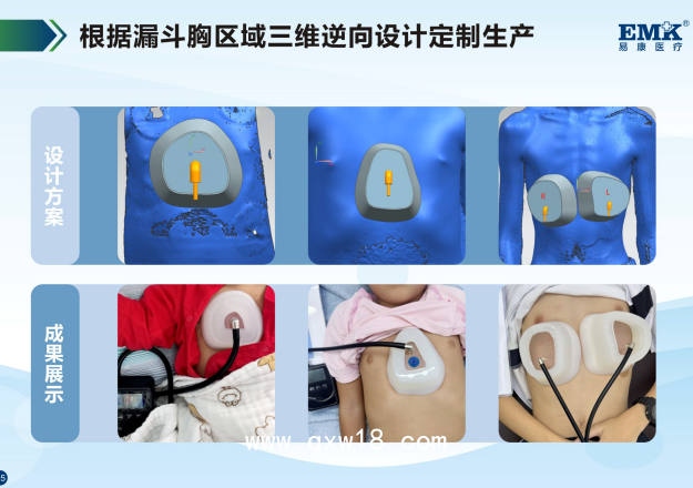 負壓理療器/漏斗胸吸盤/漏斗胸矯正器