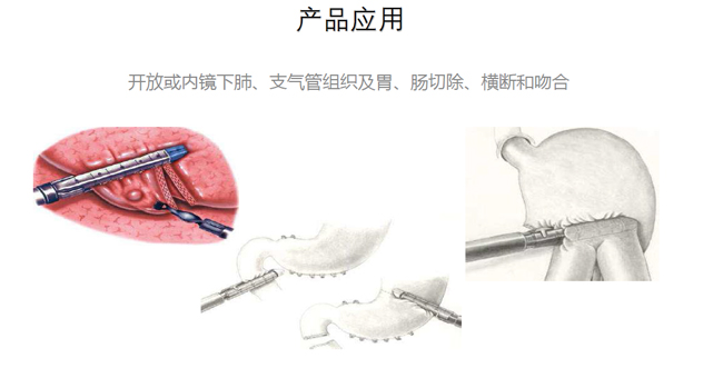 吻合器產品應用